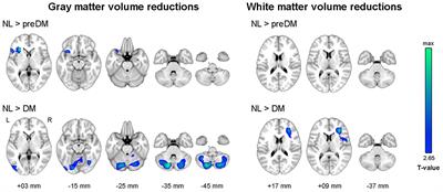 Brain Structural Alterations, Diabetes Biomarkers, and Cognitive Performance in Older Adults With Dysglycemia